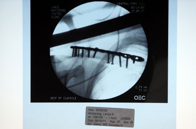 Photo of Team Astana's Lance Armstrong's clavicle / collarbone post-op. Photo by Elizabeth Kreutz courtesy of CSE.